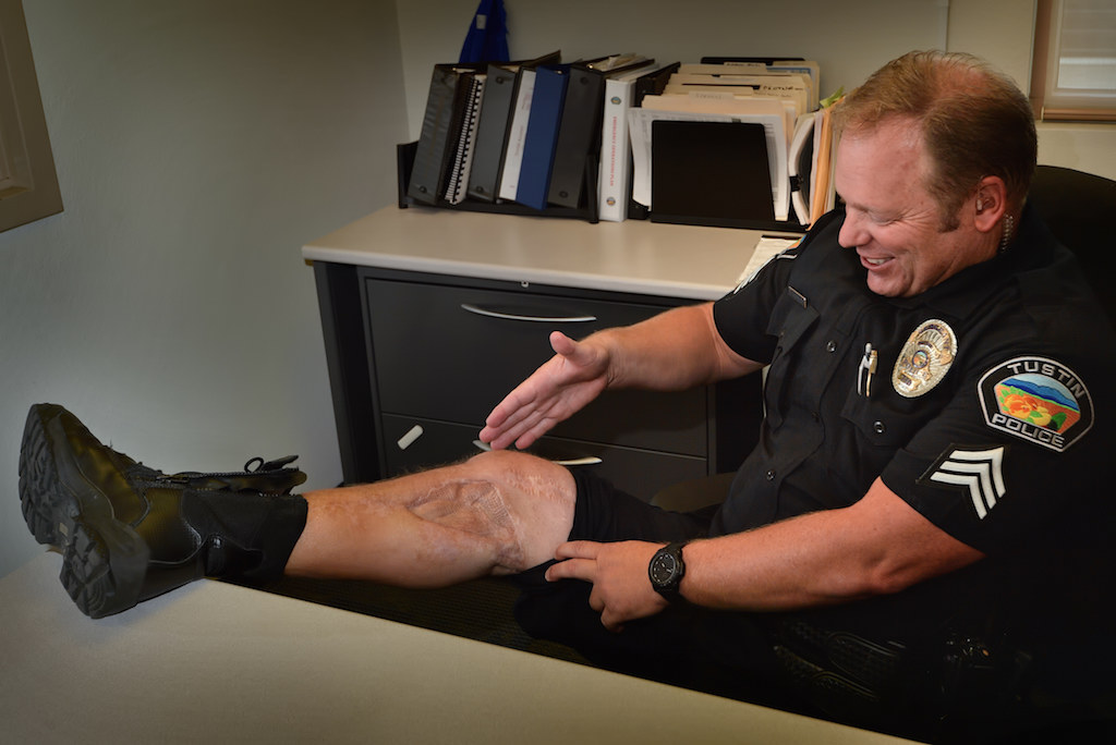 Tustin PD Sgt. Duane Havourd shows the injures to his leg from a motorcycle accident six years ago as he talks about his ability to return to the force, thanks to his determination and support from everyone at the Tustin PD. Photo by Steven Georges/Behind the Badge OC
